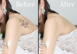 タトゥー除去