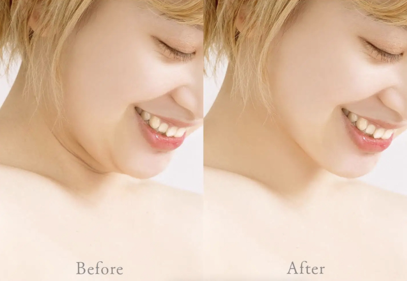 【フェイスライン/二重顎】