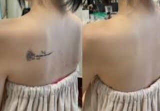 タトゥー、傷修正