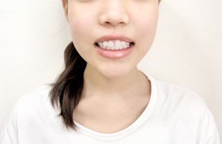 矯正器具消しレタッチ